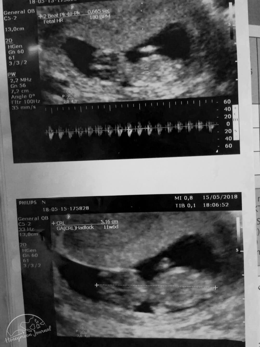 usg minggu 11 trimester pertama kehamilan kabay honeymoonjournal.com