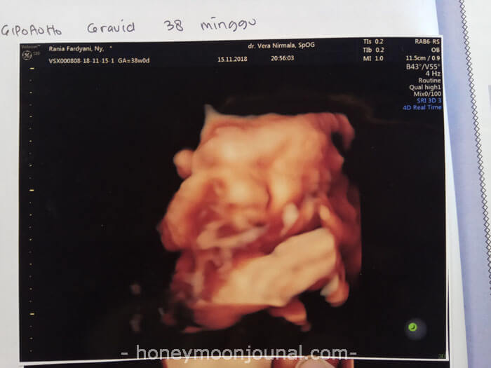 usg 4d trimester ketiga kehamilan kabay honeymoonjournal.com usg-4d-trimester-ketiga-kehamilan-kabay-honeymoonjournal-dotcom