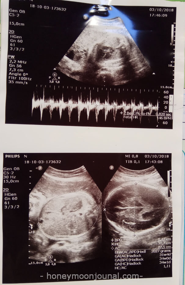 usg 2d trimester ketiga kehamilan kabay honeymoonjournal.com usg-trimester-ketiga-kehamilan-kabay-honeymoonjournal-dotcom