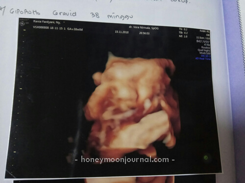 usg 4d pengalaman melahirkan induksi normal honeymoonjournal.com
