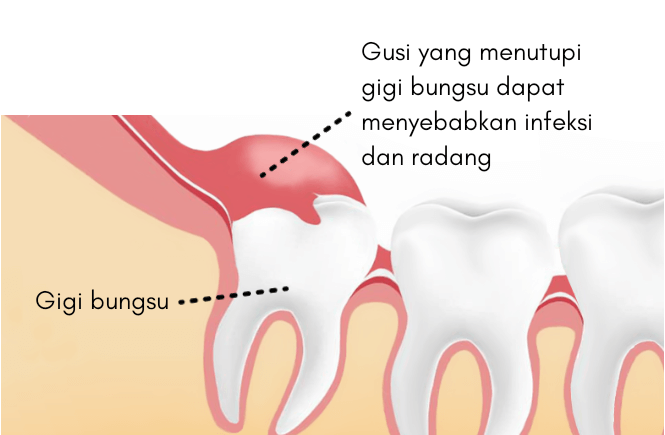 gusi gigi bungsu